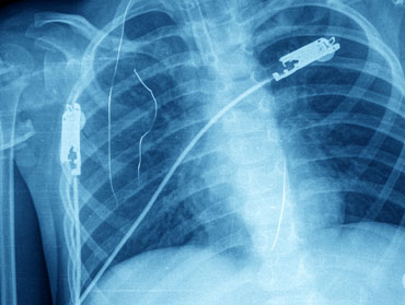 biocompatible medical strip for medical implants 