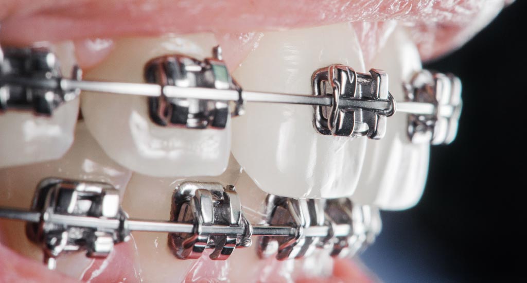 Orthodontic Brackets Orthodontic Brackets